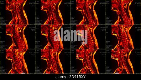 Jeu de 12 acquisitions IRM sagittales de couleur rouge du cou zone de caucasien 34 ans homme avec paramedial bilatéral Extrusion du segment C6-C7 Banque D'Images