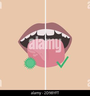 Comparaison. Taches blanches sur la langue avec des bactéries et une langue saine. Illustration de Vecteur