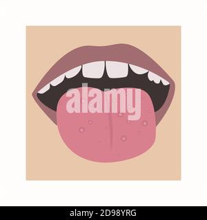 Champignon ou acné sur la langue. Vecteur de la bouche d'un enfant atteint d'une maladie. Illustration de Vecteur