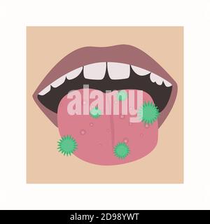 Champignon ou acné sur la langue. Vecteur de la bouche d'un enfant atteint d'une maladie Illustration de Vecteur