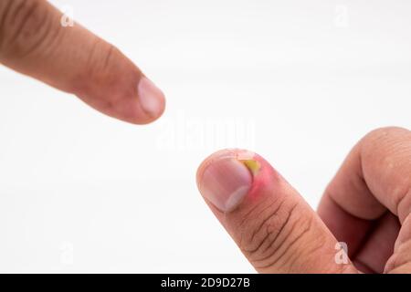 Série d'infection douloureuse de la peau des ongles avec le traitement de pus Banque D'Images