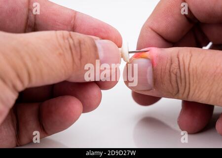 Série d'infection douloureuse de la peau des ongles avec le traitement de pus Banque D'Images