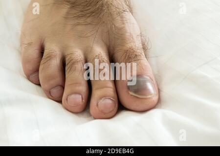 Pied mâle avec pointe noire blessée sur un drap de lit blanc. Hématome sanguin dans un ongle du pied. Fracture douloureuse des orteils. Problème de santé médicale avec les pieds humains. Accide Banque D'Images