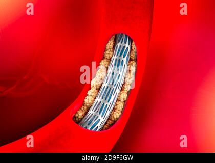 La chirurgie de pontage d'artère coronaire est une procédure chirurgicale pour restaurer le flux sanguin normal vers une artère coronaire obstruée. Angioplastie. Cholestérol Banque D'Images