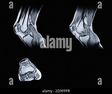 Imagerie par résonance magnétique (IRM) du genou droit. Lésion fermée de l'articulation du genou, avec manifestations d'arthrose. Banque D'Images