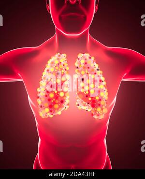 Anatomie humaine, problèmes avec le système respiratoire, poumons gravement endommagés. Pneumonie bilatérale. Covid-19, coronavirus. Patient et fumée. Fumeur. 3d Banque D'Images