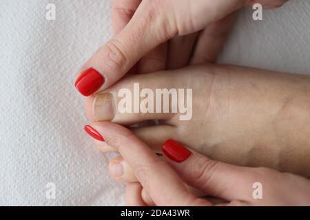 Les orteils des femmes tiennent le gros orteil avec un ongle endommagé. Banque D'Images