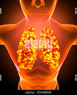 Anatomie humaine, problèmes avec le système respiratoire, poumons gravement endommagés. Pneumonie bilatérale. Covid-19, coronavirus. Patient et fumée. Fumeur. 3d Banque D'Images