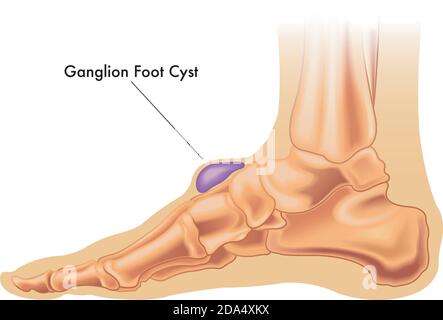 Illustration d'un kyste de ganglion sur le pied avec annotation. Illustration de Vecteur