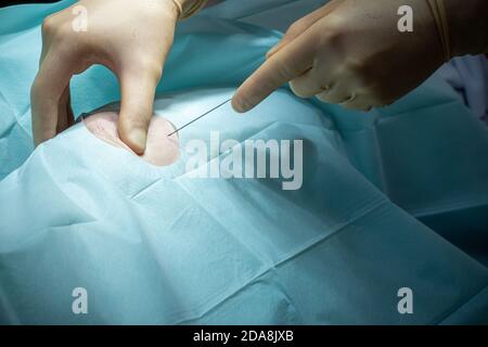 un médecin effectue une ponction du genou dans une salle d'opération avec une canule et une seringue Banque D'Images