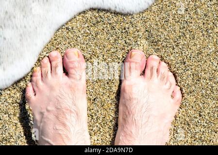 Le pied de l'homme avec une infection fongique sur le sable Banque D'Images