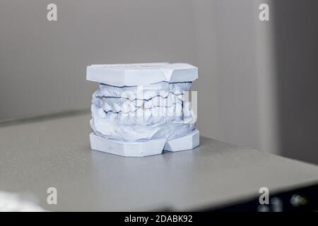 Plâtre coulé de dents à partir de plâtre à l'orthodontiste. Banque D'Images