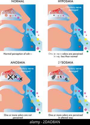 L'illustration montre de manière symbolique et simple les symptômes de trois différents troubles olfactifs. Illustration de Vecteur