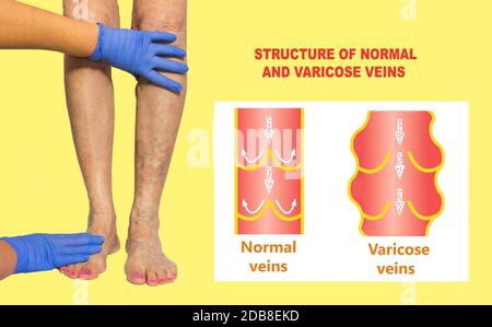 Varices sur une femme de jambes âgées. La structure des varices et normales. Collage. Examen vasculaire du membre inférieur en raison d'un suspicion de sang veineux Banque D'Images