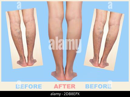 Traitement de varices avant et après. Varices sur les jambes des femmes âgées. Banque D'Images