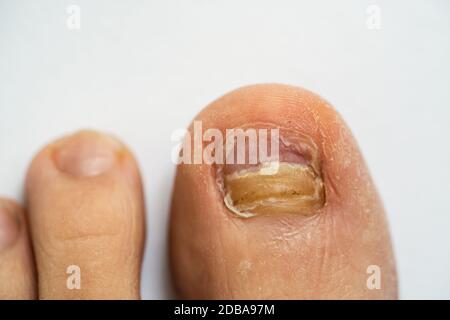 Ongles de pied mâle cassés et infection fongique Banque D'Images