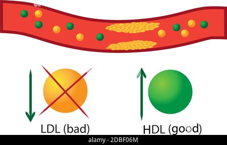 Plaque athérosclérotique dans les vaisseaux sanguins, bon et mauvais lipides leur régulation dans les infographies de vecteur sanguin Banque D'Images