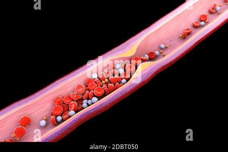 Illustration de cellules sanguines avec accumulation de plaque de cholestérol isolé Plaque de cholestérol de fond noir dans l'artère Banque D'Images