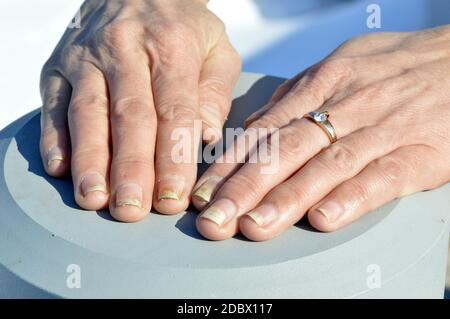 Infection fongique des ongles, onycholyse après shellac ou gel-vernis Banque D'Images