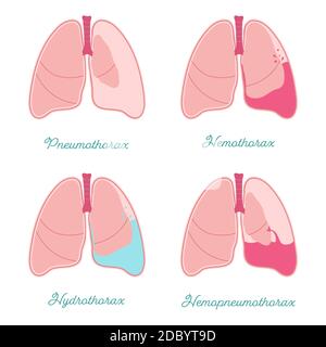 Certains types d'épanchements pleuraux. Accumulation anormale de liquide ou d'air dans l'espace pleural. L'hémothorax, le pneumothorax, l'hémopneumothorax et l'hydrothorax également. Compa Illustration de Vecteur