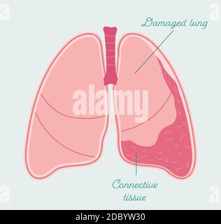 Fibrothorax - Schéma anatomique dessiné à la main. Fibrose dans la cavité pleurale, cicatrisation anormale de l'espace pleural Illustration de Vecteur