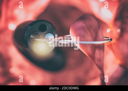 Retrait du polype de la paroi intestinale à l'aide d'un colonoscope. Dispositif médical permettant de vérifier l'état des intestins et de détecter les troubles gastro-intestinaux Banque D'Images