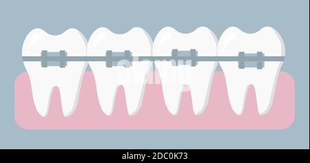 Traitement orthodontique. Bretelles sur vos dents. Concept de la dentisterie et de la médecine. Illustration vectorielle dans une conception plate. Illustration de Vecteur