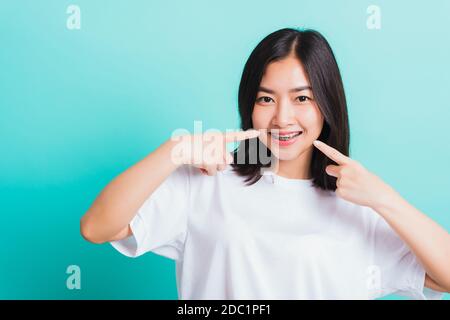 Portrait de l'asiatique de l'adolescence belle jeune femme sourire ont des bretelles dentaires sur les dents riant point doigt sa bouche, studio tourné isolé sur un backgro bleu Banque D'Images