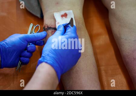 Bandage d'une blessure post-opératoire du genou. Le médecin avec des gants bleus applique un bandage. Banque D'Images