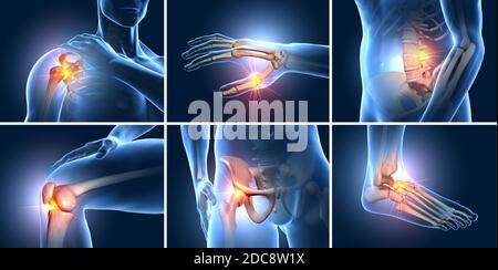 Un ensemble de six articulations douloureuses, illustration médicale 3D Banque D'Images