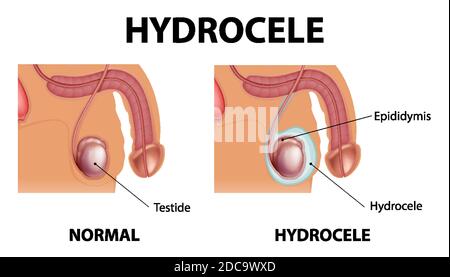 Affiche médicale montrant différents entre le testicule normal mâle et l'hydrocèle illustration Illustration de Vecteur