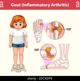 Illustration de l'information médicale sur la goutte (arthrite inflammatoire) Illustration de Vecteur