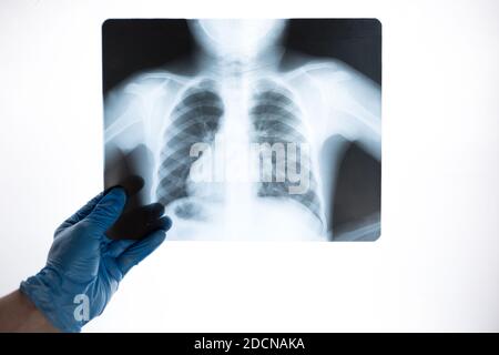 Vue rapprochée par rayons X des côtes et des poumons dans les mains d'un médecin en gants bleus. Le médecin examine la photo Banque D'Images