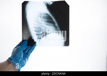 Vue en gros plan des côtes et des poumons dans les mains d'un médecin avec des gants bleus. Le médecin examine l'image de la pneumonie. Banque D'Images