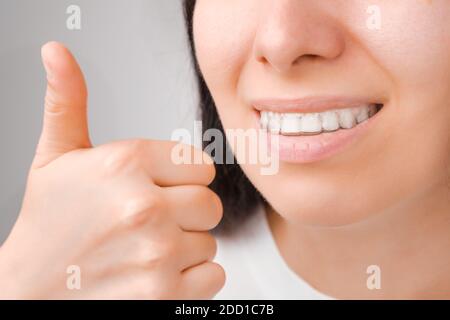 Une femme heureuse avec un sourire parfait dans des aligneurs transparents sur ses dents montre comme. Banque D'Images