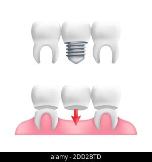 Concept de prothèse dentaire - dents saines avec un pont dentaire fixe et des implants. Illustration vectorielle des dents humaines dans un style 3d réaliste isolé sur une wh Illustration de Vecteur