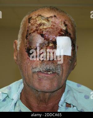 PAS DE FILM, PAS DE VIDÉO, PAS de télévision, PAS DE DOCUMENTAIRE - photo montrant le visage de Ronald Poppo&apos, sorti par l'hôpital Jackson Memorial le mardi 12 juin 2012, à Miami, Floride. Poppo, un homme sans domicile qui avait son visage, s'est surtout défait lors d'une attaque bizarre de Rudy Eugene. Photo de l'hôpital Jackson Memorial via Miami Herald/MCT/ABACAPRESS.COM Banque D'Images