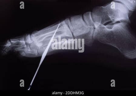 Rayons X de pied de corps étranger d'un enfant image radiographique d'un ongle perçant à travers un doigt. Image conceptuelle des lésions industrielles. Banque D'Images