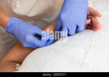 kinésithérapeute donnant le traitement avec l'acupuncture à aiguille sèche au patient dedans les mains Banque D'Images