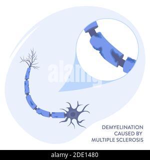 Sclérose en plaques, illustration Banque D'Images
