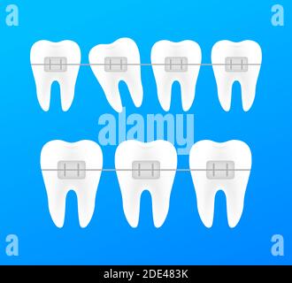 Correction des dents avec les renforts d'orthodontie. Étapes de l'alignement des dents. Les services d'une clinique dentaire. Vector illustration. Illustration de Vecteur