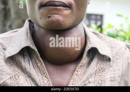 Irine Akinyi, 28 ans, victime d'un empoisonnement au plomb dans le village d'Uwino Uhuru à Changamwe, vu après une interview avec la presse. Elle souffre de problèmes rénaux et thyroïdiens en raison de l'exposition à l'empoisonnement au plomb d'une entreprise de fusion de batteries au plomb dans son quartier. L'entreprise a été fermée jusqu'à présent, mais les dommages laissés pour compte ont été mortels. Dans une décision de Landmark rendue plus tôt cette année, le gouvernement et les deux investisseurs privés ont reçu l'ordre de payer aux victimes 1.3 milliards de ksh équivalent à 12 millions de USD comme indemnité, une affaire que le gouvernement par l'intermédiaire du procureur général a apaa Banque D'Images