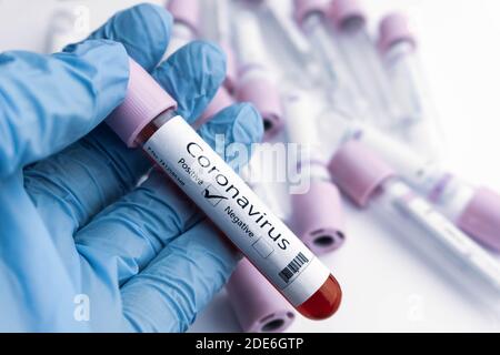 Test positif COVID-19 et échantillon de laboratoire de tests sanguins pour le diagnostic nouveau concept de rupture du coronavirus. Banque D'Images