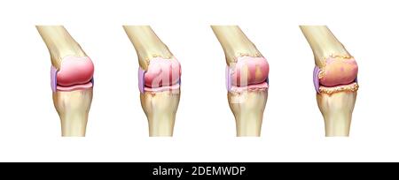 anatomie de l'arthrite du genou Banque D'Images