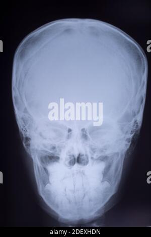 Détail des rayons X du cou et de la tête du os du crâne en projection directe Banque D'Images