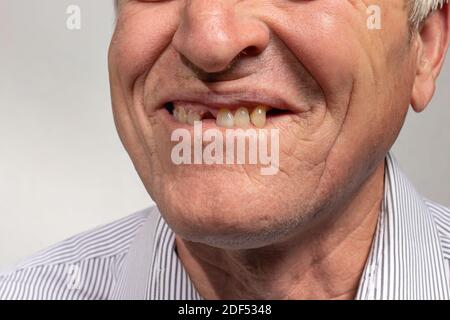 Le sourire édenté d'un vieil homme européen sur fond gris. Dentisterie pour les retraités, bonne vieillesse Banque D'Images