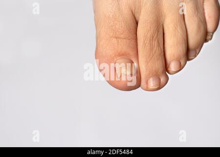 Champignon des ongles sur le gros orteil - dermatoomycose et onychomycose, infection fongique macro photo. Banque D'Images