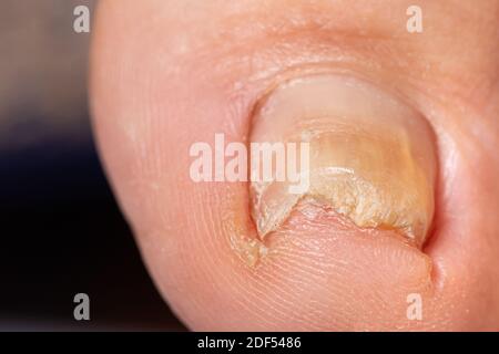 Champignon des ongles sur le gros orteil - dermatoomycose et onychomycose, infection fongique macro photo. Banque D'Images