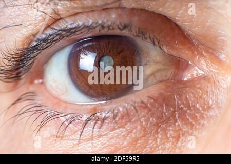 Macro photos de l'œil humain - cataracte assombrissement de la lentille, détérioration de la vision. Traitement de la cataracte, chirurgie et ophtalmologie Banque D'Images