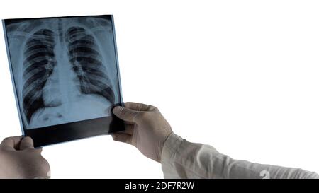 Rayons X des poumons humains isolés sur blanc, le médecin examine les poumons humains dans l'image, la pneumonie, l'oedème pulmonaire. Banque D'Images